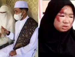Pria ini Buktikan Kesetiaan dengan Menikahi Kekasih yang Wajahnya Rusak Akibat Kecelakaan